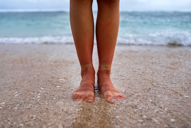 Blick auf die sonnenverbrannten Füße einer Frau vom Tragen von Sandalen am Strand