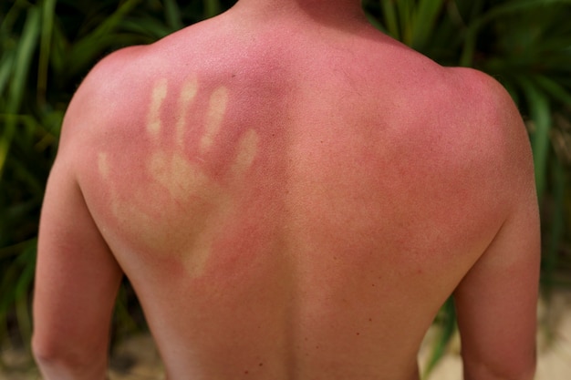 Kostenloses Foto blick auf einen mann mit sonnenbrandhaut am strand