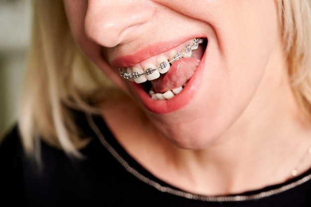 Blonde Frau, die Zähne mit Metallklammern leckt