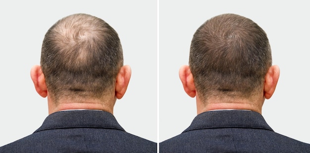 Der kopf eines mannes mit glatze vor und nach einer haartransplantation ist ein mann geworden, der seine haare verliert