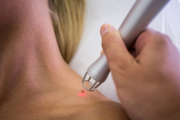 Dermatologe entfernt Maulwurf von der Schulter der Frau