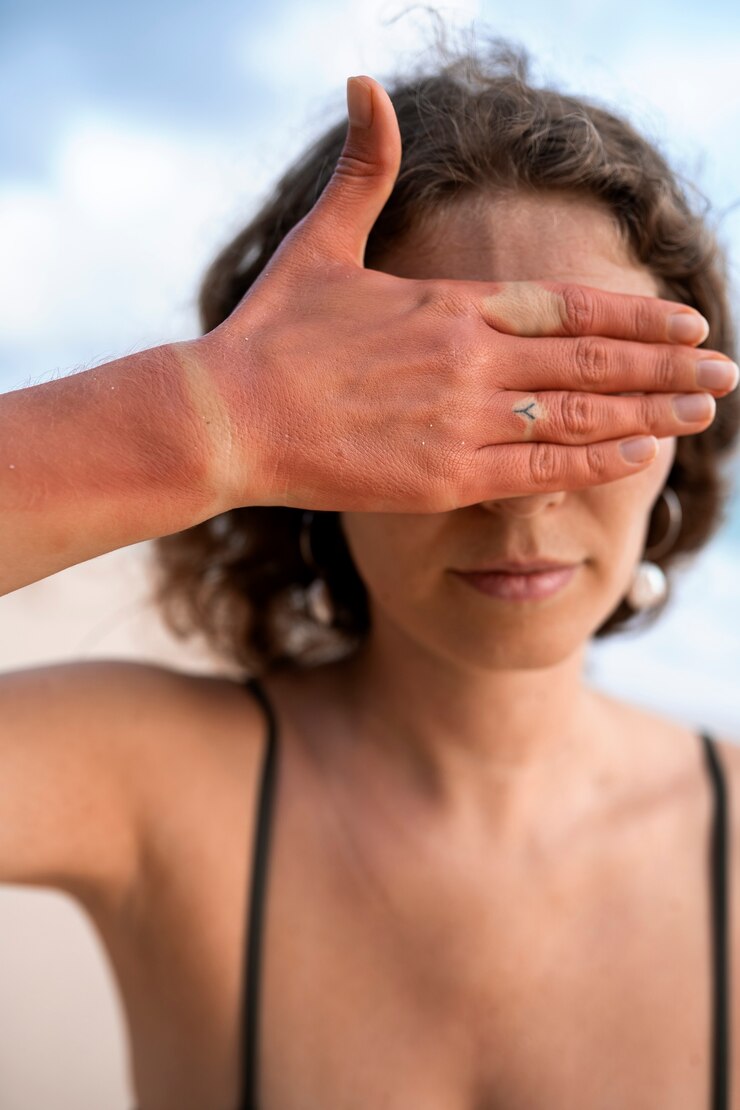Kostenlose Foto details der sonnenbrandhaut einer frau von der strandsonne