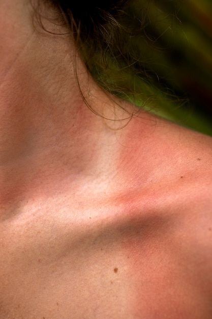 Details der Sonnenbrandhaut einer Frau von der Strandsonne