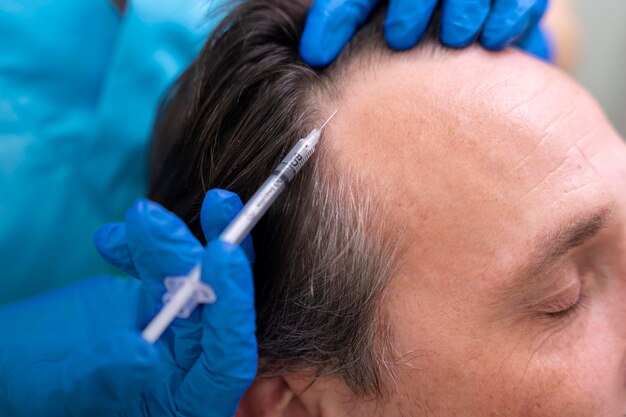 Erwachsener Mann, der eine Haarausfallbehandlung erhält