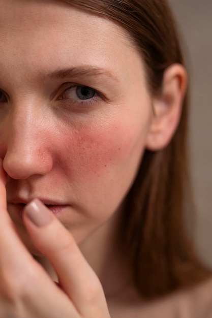 Frau, die sich mit Rosacea-Hautzustand im Gesicht befasst