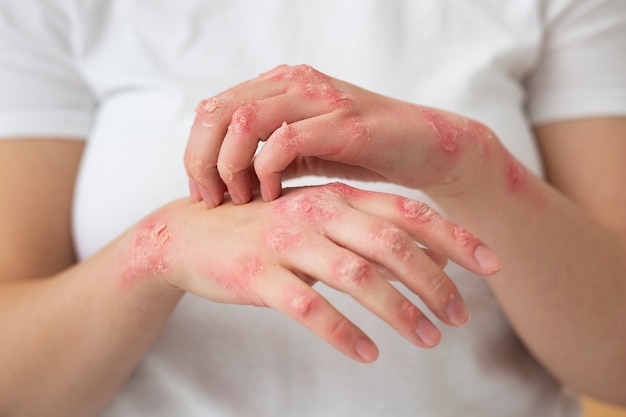 Hände eines Patienten, der an Psoriasis leidet