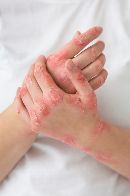 Hände eines Patienten, der an Psoriasis leidet