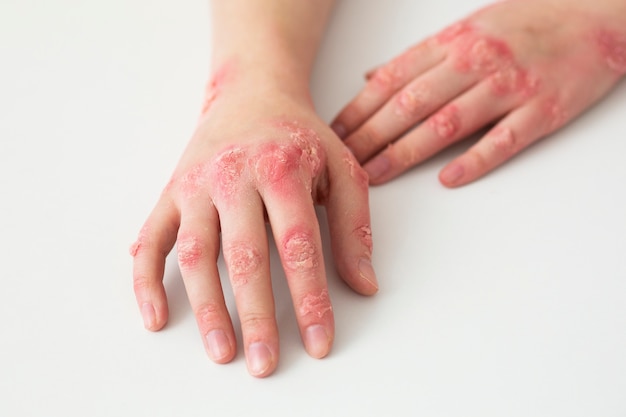 Hände eines Patienten, der an Psoriasis leidet