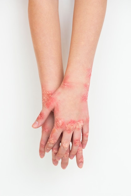 Hände eines Patienten, der an Psoriasis leidet