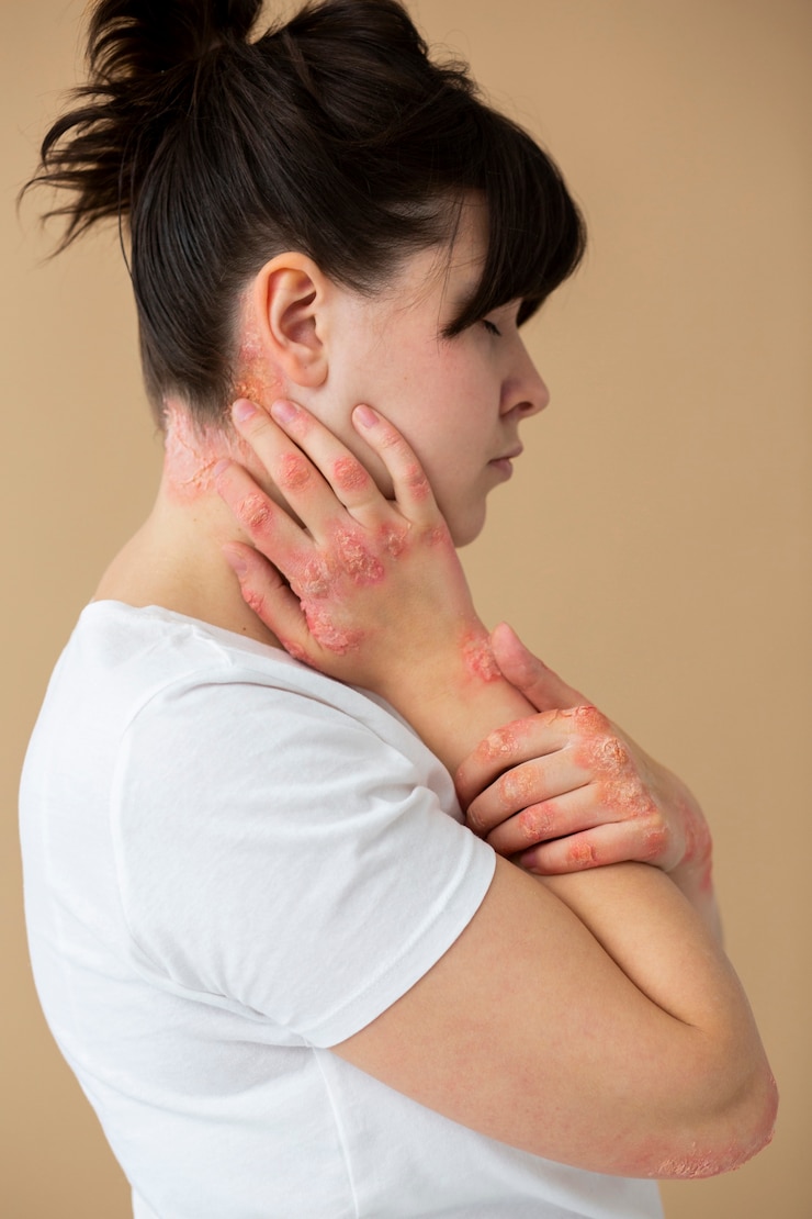 Kostenlose Foto hände eines patienten, der an psoriasis leidet