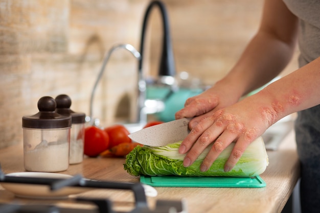 Hände eines Patienten, der an Psoriasis leidet