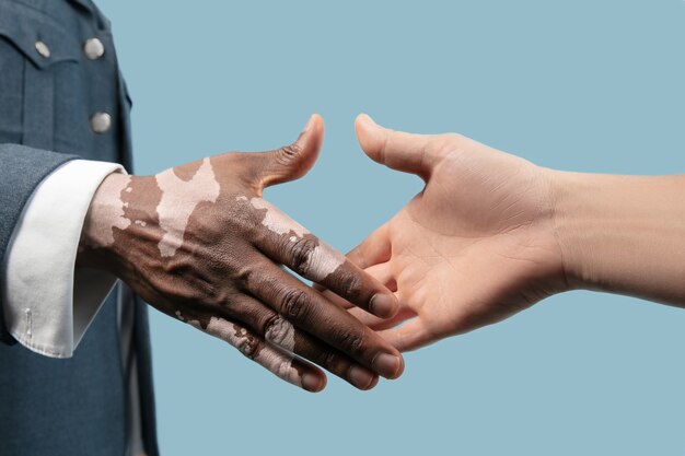 Nahaufnahme der männlichen Hände mit Vitiligo-Pigmenten lokalisiert auf blauem Hintergrund.