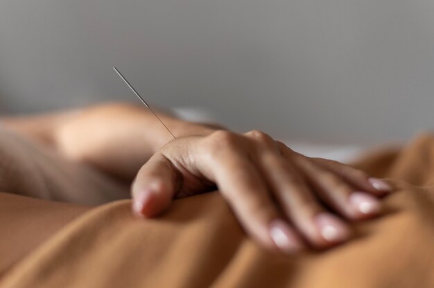 Nahaufnahme Hand mit Akupunkturnadel