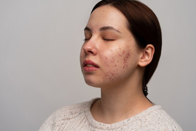 Person, die mit Rosacea zu tun hat