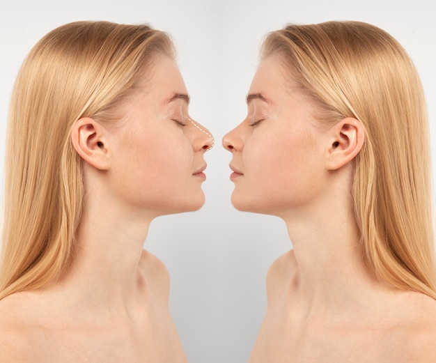 Kostenloses Foto rhinoplastik-chirurgie-konzept mit frauenmodell