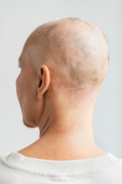 Rücksicht auf eine Frau mit Hautkrebs