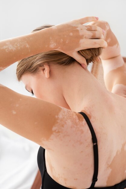 Schöne junge Frau mit Vitiligo