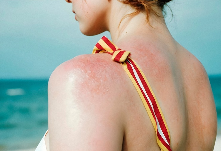 Kostenlose Foto sonnenbrand an der schulter einer frau am strand