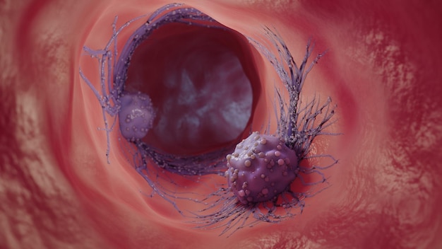 3D-Darstellung einer KrebszelleDie Ausbreitung der Krankheit im Körper Medizinisches Konzept