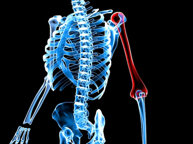 3d übertrug Abbildung eines Skeletts mit dem schmerzlichen Arm