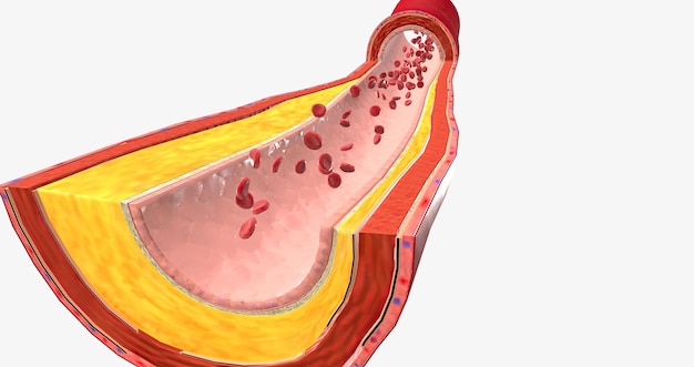 A aterotrombose é uma doença cardiovascular caracterizada pela ruptura da placa aterosclerótica e formação de coágulos