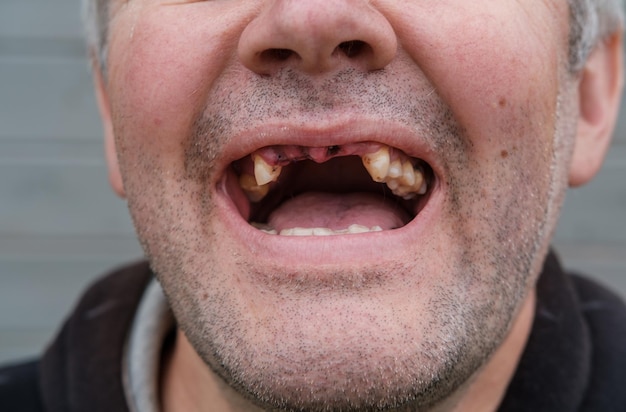 A boca aberta do homem após a extração dos dentes superiores