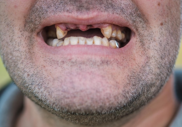 A boca aberta do homem após a extração dos dentes superiores