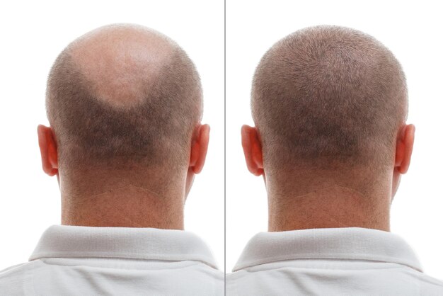 Foto de Renderização 3d De Uma Cabeça Masculina Sem Cabelo e mais fotos de  stock de Cabeça Humana - Cabeça Humana, Calvície, Careca - iStock