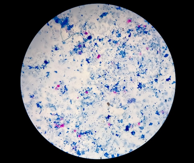 A coloração AFB do esfregaço de escarro sob microscopia mostra a bactéria Macrobacterium tuberculosis