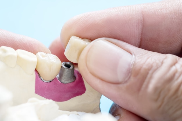 A coroa dentária e a ponte implantam equipamentos de odontologia e restauração expressa do modelo.