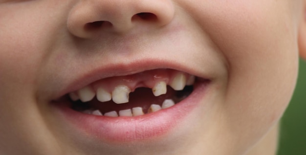 A criança perdeu um dente Foco seletivo Conceito de dente de leite