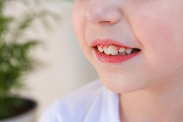 A criança tem dentes tortos O conceito de aglomeração de molares