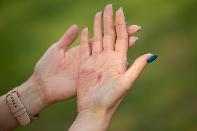 Foto a dermatite atópica ad também conhecida como eczema atópico é um tipo de inflamação da dermatite da pele nas mãos