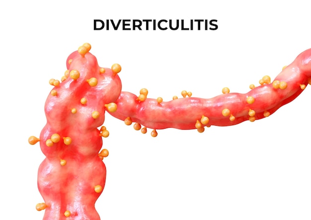 A diverticulite é uma doença que ocorre quando os divertículos do intestino grosso ficam inflamados ou infectados, podendo apresentar abscesso ou perfuração. ilustração 3D