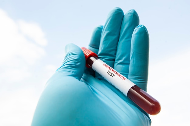 A enfermeira segurando um tubo de teste de sangue com o teste de Coronavírus