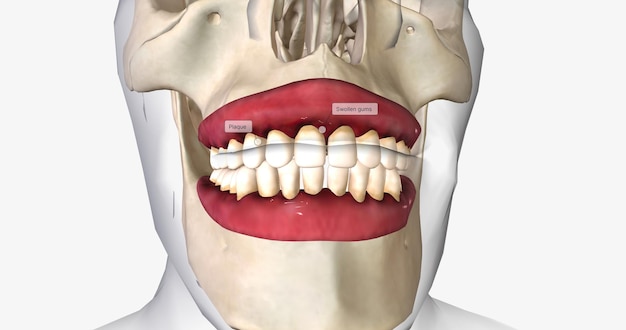 Foto a gengivite é uma forma branda de doença periodontal gengival caracterizada por gengivas sensíveis e inflamadas