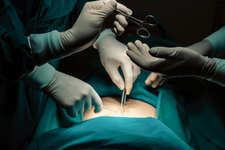 Foto a imagem da equipe cirúrgica realiza a cirurgia, a enfermeira distribui uma tesoura estéril