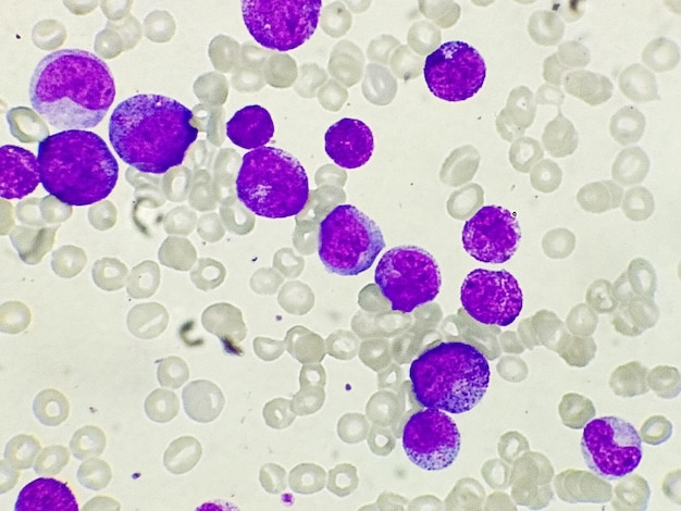 A leucemia mieloide aguda (LMA) é um tipo de câncer no sangue. Exame microscópico de células blásticas.