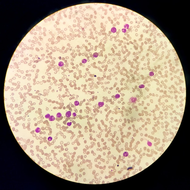 Foto a leucemia mieloide aguda (lma) é um tipo de câncer no sangue. exame microscópico de células blásticas.