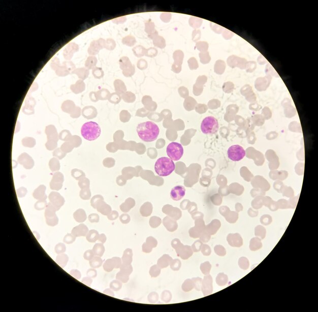 A leucemia mieloide aguda (LMA) é um tipo de câncer no sangue. Exame microscópico de células blásticas.