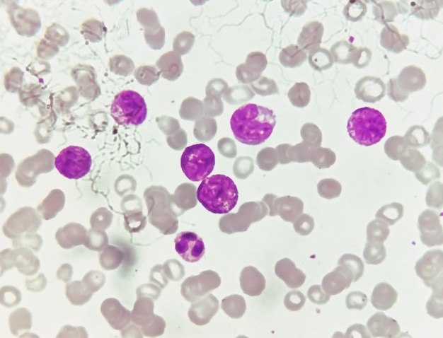 A leucemia mieloide aguda (LMA) é um tipo de câncer no sangue. Exame microscópico de células blásticas.