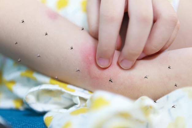 A menina tem alergia a erupções cutâneas e comichão no braço por picada de mosquito.