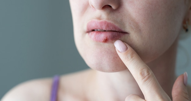 A mulher com um vírus herpes nos lábios.