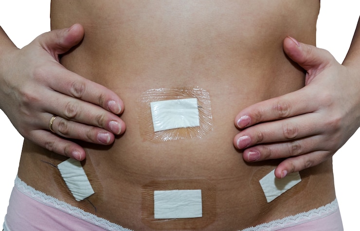 Foto abdomen femenino después de laparoscopia ovárica