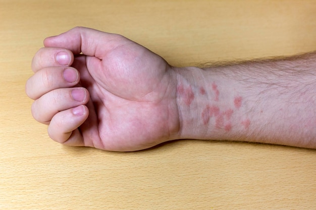 Foto abgeschnittene hand einer infizierten person auf dem tisch