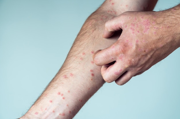 Abgeschnittenes Foto eines Mannes, der an Psoriasis leidet und mit den Fingern dicke, schuppige rote Hautausschläge auf der Haut des Arms kratzt