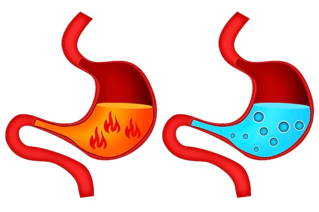 Acidez de estómago y gastritis en el estómago.