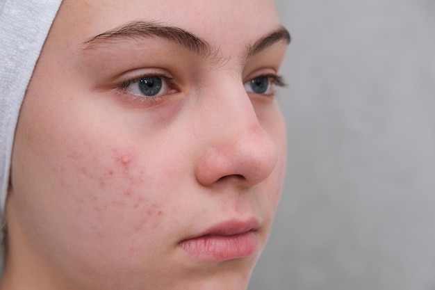 Acne Adolescente com as espinhas no rosto Pele problemática Closeup