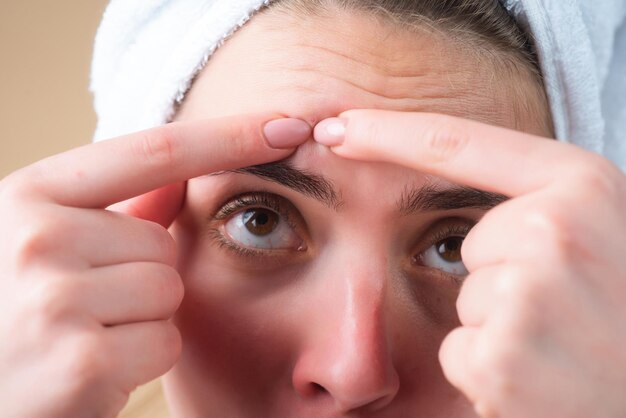 Foto acne de perto acne espinha na pele feminina dermatologia puberdade mulher reação cutânea de acne cosmética