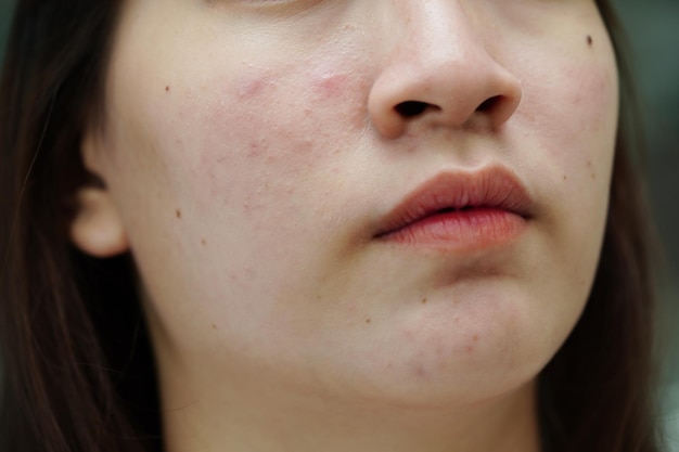 Acne espinhas e cicatrizes na pele rosto distúrbios das glândulas sebáceas adolescente cuidado da pele problema de beleza